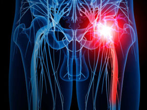 Sciatic Nerve, Sciatica, Low Back Pain